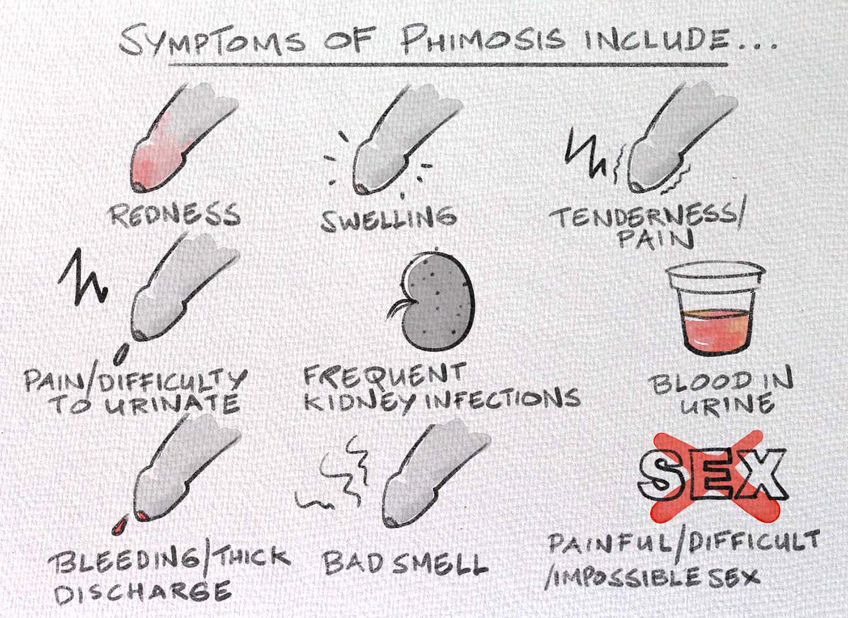Phimo Problem Phimosis – Dr Macks